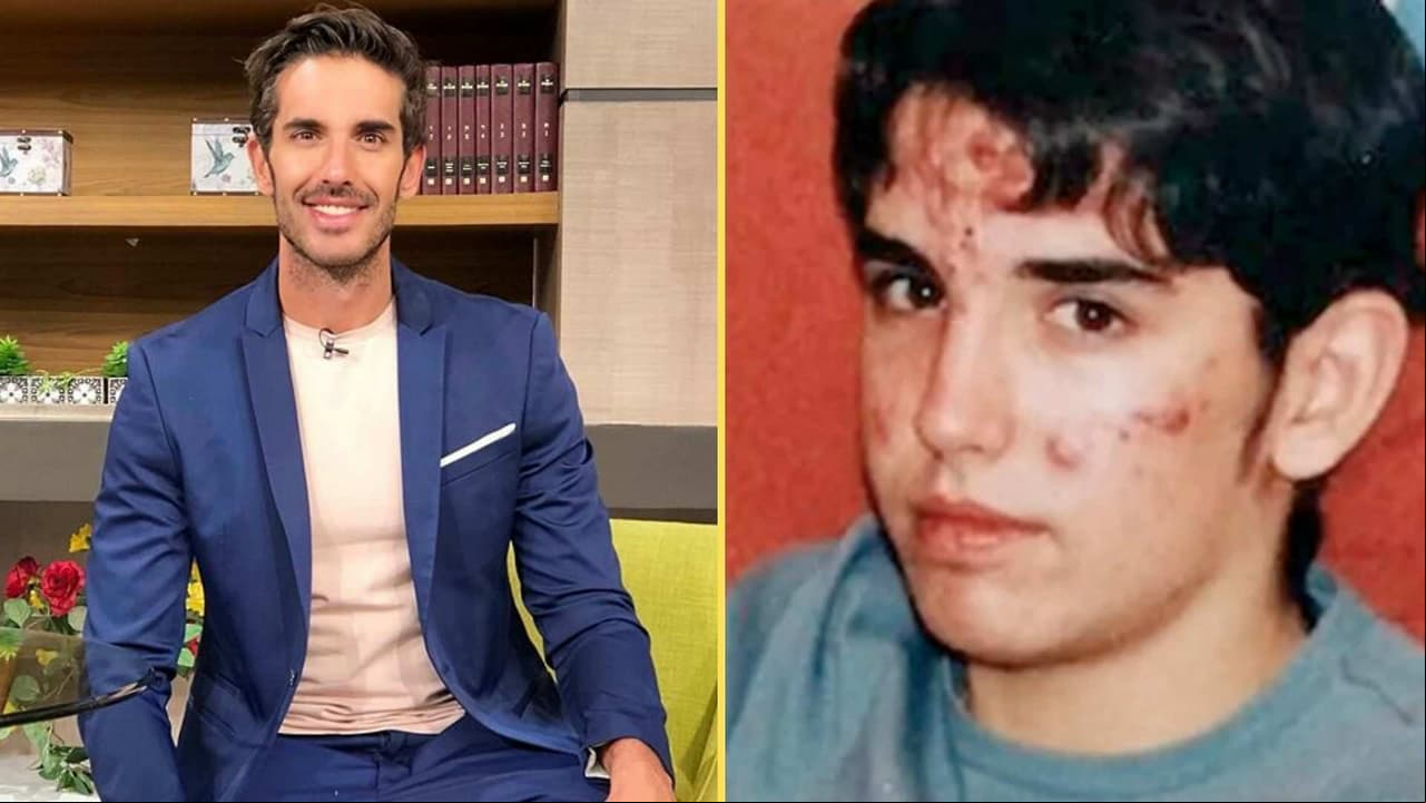 Pedro Prieto recuerda lo doloroso que fue padecer acné durante su adolescencia: “Me acomplejaba muchísimo”
