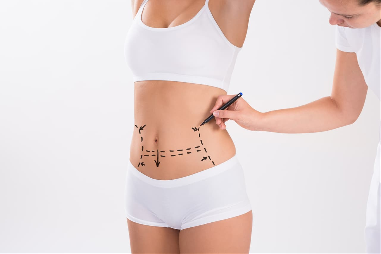 Lipoescultura: también denominada liposucción, consiste en la extracción de grasa corporal por medio de la succión.