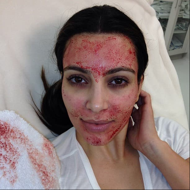 Faciales vampiros. Utiliza el tratamiento de bioestimulación facial de plaquetas, el cual consiste en la extracción de una pequeña cantidad de sangre, la cual se inyecta en el rostro. Esto le permite lucir un rostro libre de acné y sin arrugas.