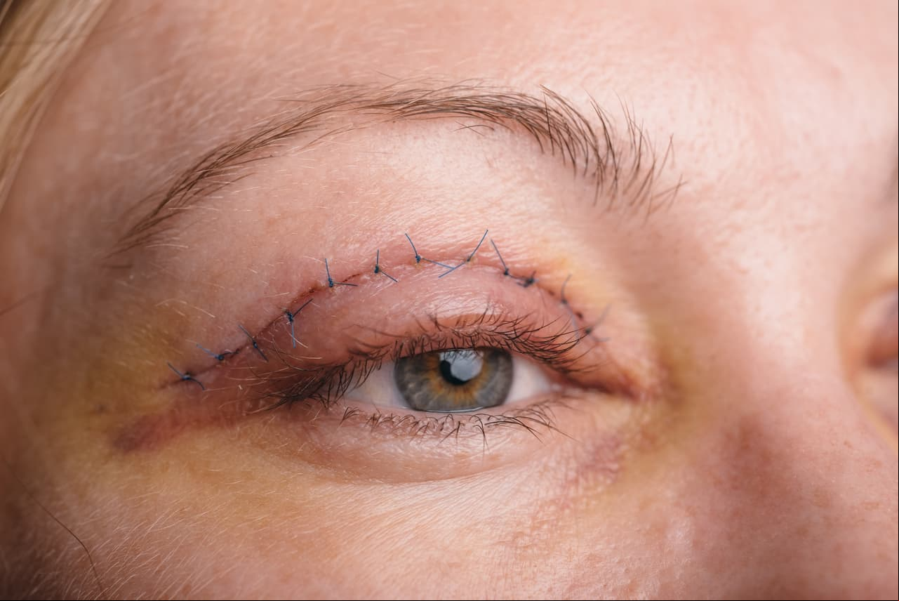 Blefaroplastia o cirugía de párpado: es una cirugía que remueve el exceso de piel en los párpados hundidos o caídos.