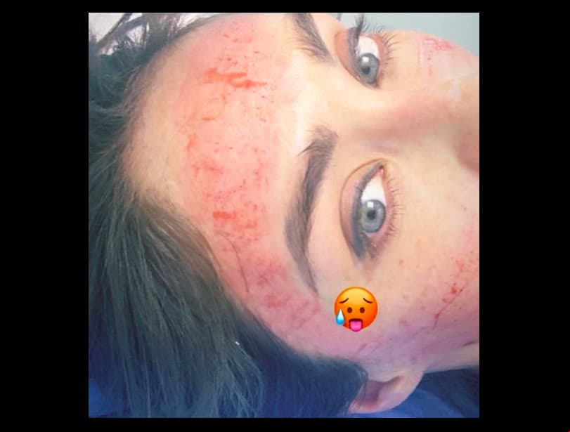 A través de sus historias de Instagram, Anahí mostró el tratamiento facial al que se sometió en manos del Dr. Ruíz. El Plasma Rico en Plaquetas (RPR) o Facial Vampiro permite regenerar las células del cuerpo y darle una apariencia más fresca. De acuerdo con el especialista, este procedimiento es inofensivo para la piel.