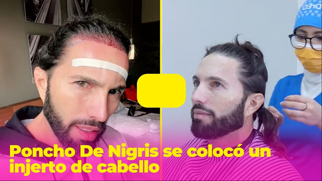 Poncho de Nigris aparece irreconocible tras injerto de cabello y lo comparan con Sebastián Yatra
