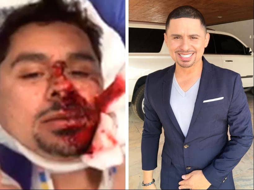 Larry Hernández. En 2017 sufrió un accidente mientras realizaba un Facebook Live cuando viajaba en su bicicleta. El golpe hizo que tuviera desprendimiento de pómulo y provocó que perdiera gran parte de su dentadura.