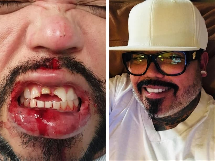 A.B. Quintanilla. En 2015, el hermano Selena, se golpeó la cara durante la celebración de sus 52 años, lo que provocó que se le rompieran tres dientes. Según contó, esto sucedió por el avanzado estado de ebriedad en el que estaba.