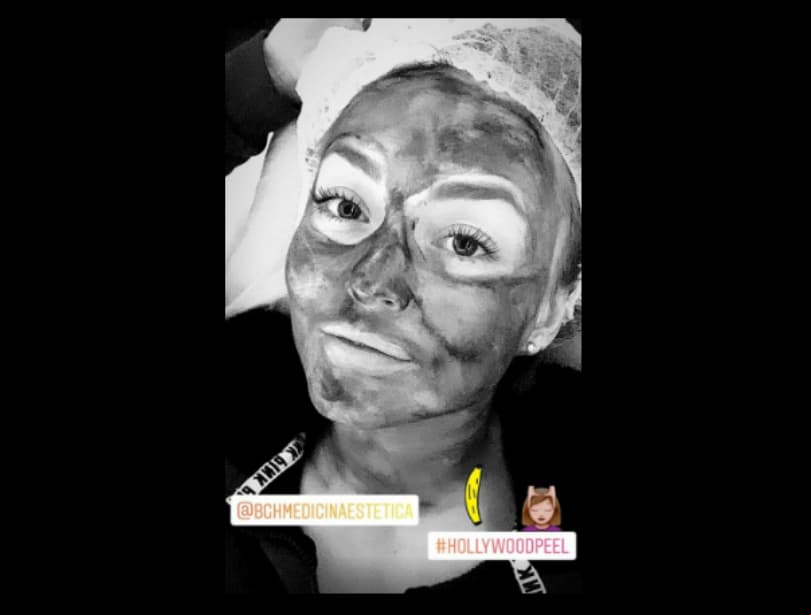 A diferencia de sus colegas, Angelique Boyer prefiere el Hollywood Peel, un tratamiento que reduce el tamaño de los poros, elimina las manchas, estimula el colágeno, controla la producción de grasa, elimina las marcas de acné y líneas de expresión. Para este tratamiento, la famosa se puso en manos del especialista Bernardo Goldzweig.